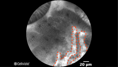 3 Vessels with normal calibre (honey-comb like or coil-shaped).png