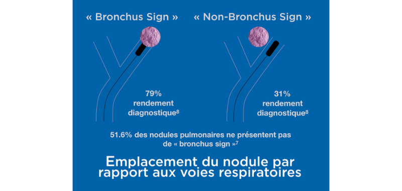 Bronchus sign FR.png