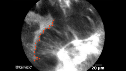 1 Epithelial surface appearing saw-toothed.png 1 Epithelial surface appearing saw-toothed.png