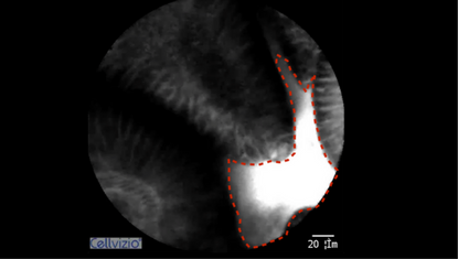 2 Glandular atrophy with markedly dilated opening and decreased gastric pits - Atrophic Gastritis.png