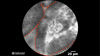 1 Columnar epithelium with villous appearance.png