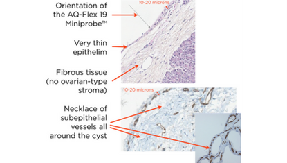 1 Serous cystadenoma pathology.png