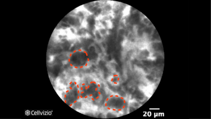 5 Pleomorphic and enlarged cells.png 5 Pleomorphic and enlarged cells.png