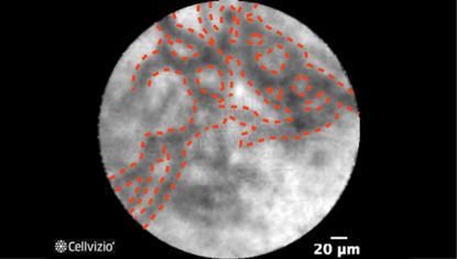 1 Reticular network of thin dark branching bands (<20 microns).png