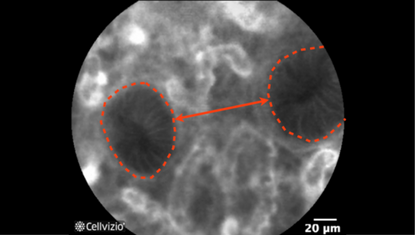 1 Differences in shape, size and distribution of crypts; increased distance between crypts, focal crypt distribution.png