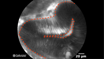 2 Irregular or villiform structures.png