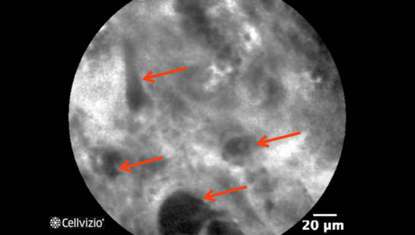 2 Loss of pits, appearance of irregular dark cells - Poorly Differentiated Adenocarcinoma.png 2 Loss of pits, appearance of irregular dark cells - Poorly Differentiated Adenocarcinoma.png