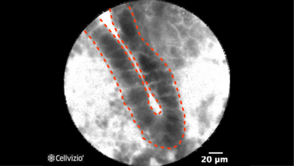 2 Dark, irregularly thickened epithelium.png