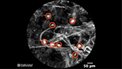 2 Destroyed alveoli.png