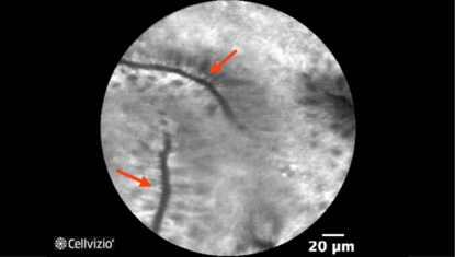 1 Bright non-thickened, uniform epithelium.png