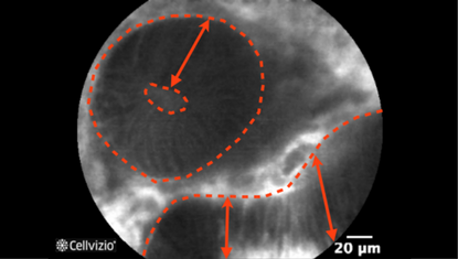 3 Dark, irregularly thickened epithelium.png