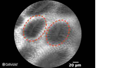 Gastric Metaplasia - Round and regular glands (gastric pits).png