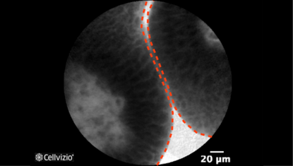 3 Papillary and well-organized architecture (increased thickness).png