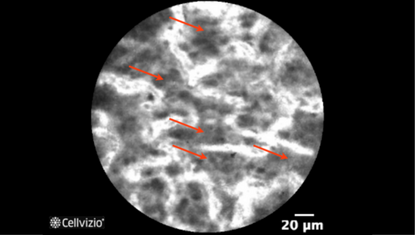 2 Loosely, infiltrative cells in lamina propria.png 2 Loosely, infiltrative cells in lamina propria.png