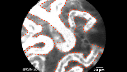 2 Mild to moderate increase of capillaries, dilated and distorted capillaries.png