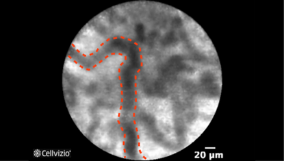 1 Thickened reticular structures.png