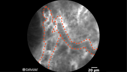 2 Dilated and disorted vessels with increased leakage, Irregular architecture with little or no orientation to adjunct tissue.png