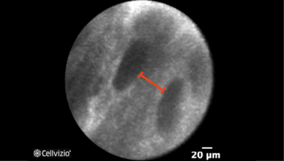 4 Increased inter-glandular space.png 4 Increased inter-glandular space.png