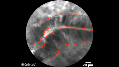 1 Ridged-lined irregular epithelial layer with loss of crypts and goblet cells, Irregular cell architecture with little or no mucin.png