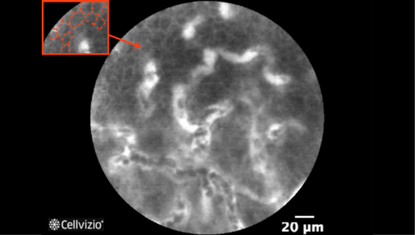 1 Small monomorphic cells with distinct cell border.png