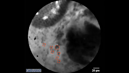 3 Cell shedding into the lumen (dark dots) - Origin: CLE Positive reaction after provocation.png 3 Cell shedding into the lumen (dark dots) - Origin: CLE Positive reaction after provocation.png