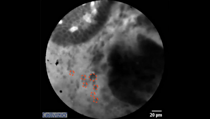 3 Cell shedding into the lumen (dark dots) - Origin: CLE Positive reaction after provocation.png