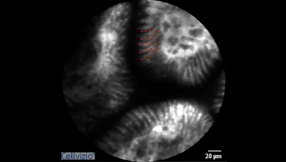 2 Bright villi .png