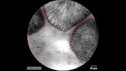 2 Fluorescence leakage into the lumen (bright lumen, often brighter than the villi) - Origin: CLE Positive reaction due to leaky gut.png 2 Fluorescence leakage into the lumen (bright lumen, often brighter than the villi) - Origin: CLE Positive reaction due to leaky gut.png