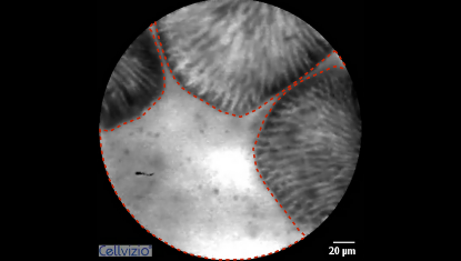 2 Fluorescence leakage into the lumen (bright lumen, often brighter than the villi) - Origin: CLE Positive reaction due to leaky gut.png