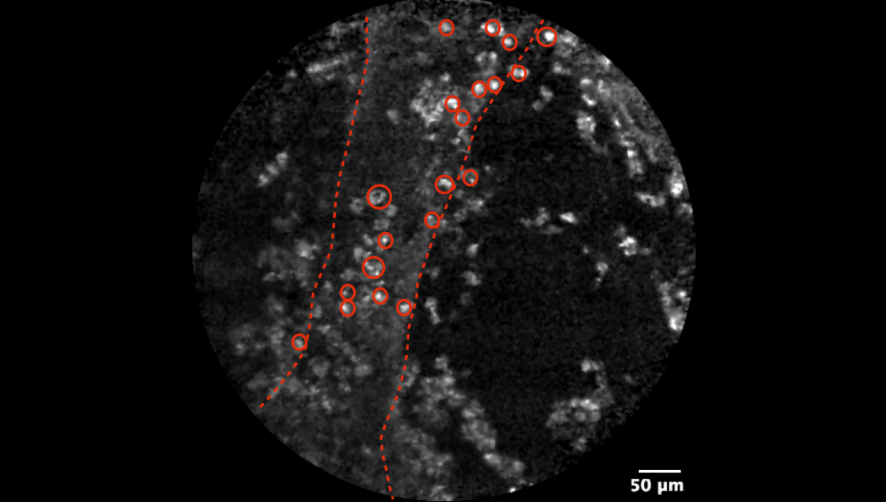 Lung transplant - Perivascular Cellularity (ex2).png Lung transplant - Perivascular Cellularity (ex2).png