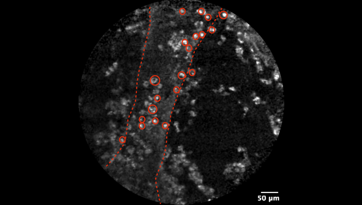 Lung transplant - Perivascular Cellularity (ex2).png