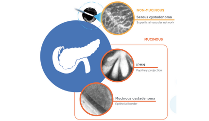 Panc Cyst.png