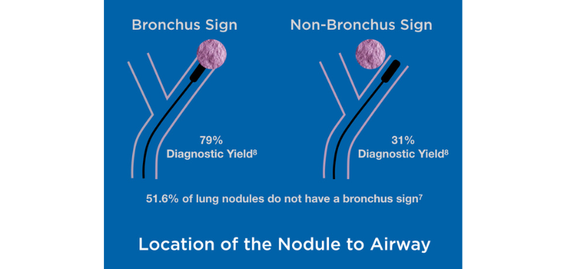Bronchus Sign.png