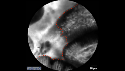 1 Fluorescence leakage into the lumen (bright lumen, often brighter than the villi) - Origin: CLE Positive reaction after provocation.png 1 Fluorescence leakage into the lumen (bright lumen, often brighter than the villi) - Origin: CLE Positive reaction after provocation.png